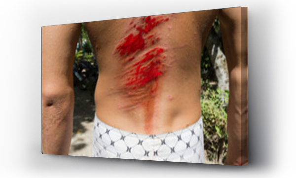 Wizualizacja Obrazu : #566828382 Open bloody wound on back of man after surf incident, Lombok, Sumbawa, Indonesia